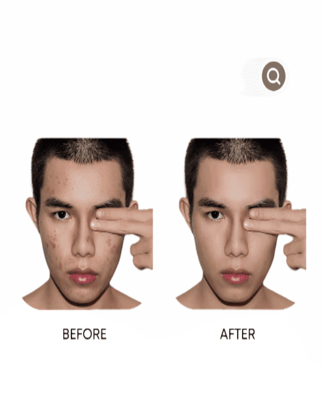 Organic Anti-Acne Three-Step System - Moderate/Severe Acne Prone Skin - For MEN